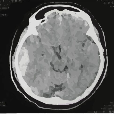 頭部外傷のCT画像