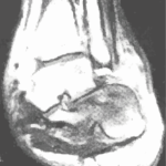 踵骨骨折のCT画像